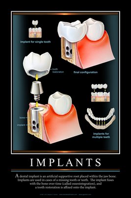 "IMPLANTS" - (black) Dental Wall Chart DWC121