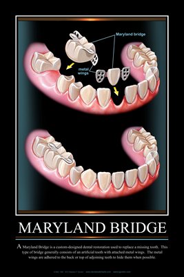 "MARYLAND BRIDGE" - (black) Dental Wall Chart DWC131