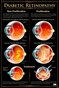 DIABETIC RETINOPATHY Eye Wall Chart #515