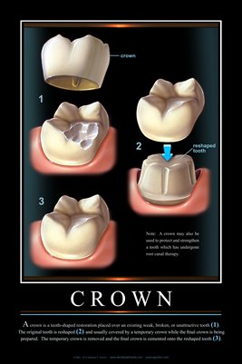 "CROWN" - (black) Dental Wall Chart DWC111