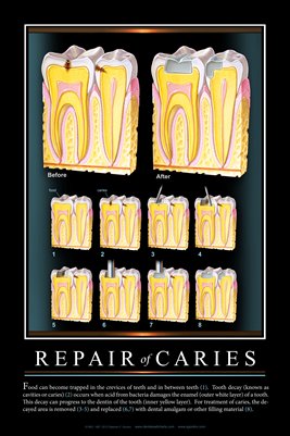 "REPAIR OF CARIES" #2 - (black) Dental Wall Chart DWC503