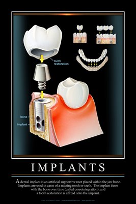 "IMPLANTS" #2 - (black) Dental Wall Chart DWC123