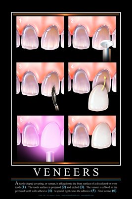 "VENEERS" - (black) Dental Wall Chart DWC171