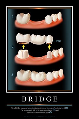"BRIDGE" - (black) Dental Wall Chart DWC901