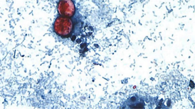 Federal health officials have investigated 5 different clusters of cyclosporiasis cases, FDA says Federal health officials have investigated 5 different clusters of cyclosporiasis cases, FDA says