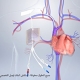 Hickman Line Insertion Procedure