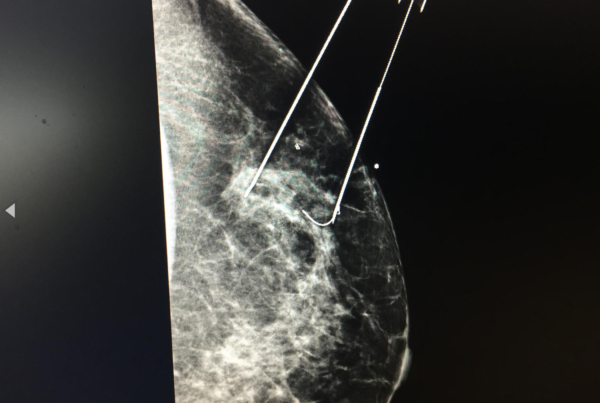 Aspirin May Help Obese Breast Cancer Patients