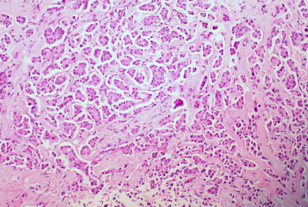 A New Drug That Fights Cancer, Wherever It Is In The Body, Shows Promise