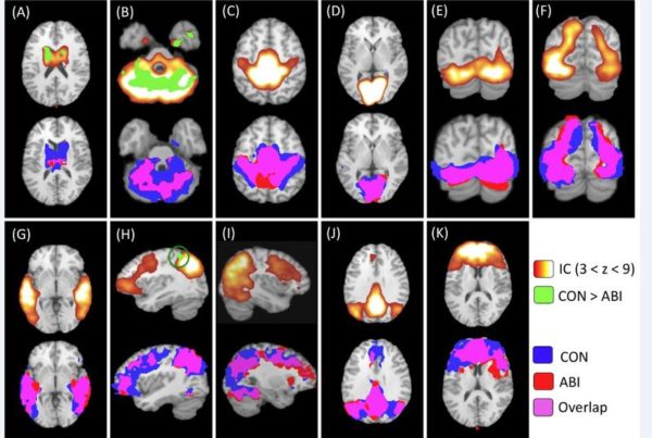 San Antonio Study Shows Drowning Victims’ Brains Are Largely Intact