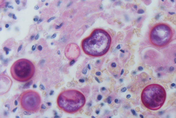 San Antonio Researcher Gets $2 Million To Fight Valley Fever