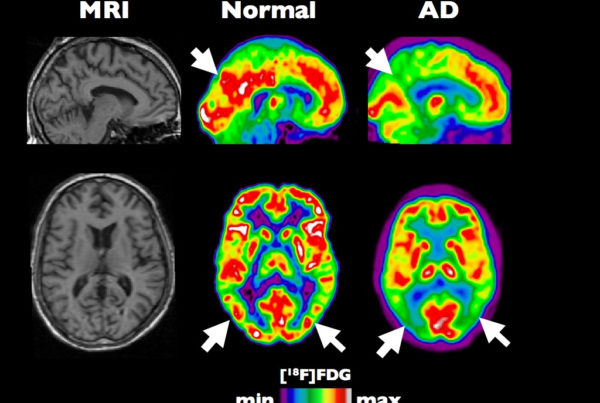 FDA Approves Alzheimer’s Drug: Why Some Doctors Say, ‘Not So Fast’