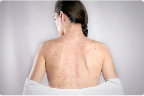 Decline In MMR Vaccination Puts Pregnant Women And Babies At Risk