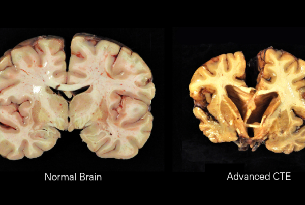A side by side image shows what looks like a "slice" of what is labeled a normal brain on the left and a brain labeled advanced CTE on the right. The brain with CTE is yellowed, much smaller and less symmetric than the other brain.