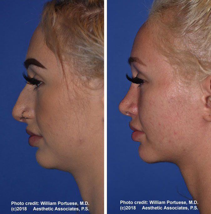 Rhinoplasty Portland Oregon