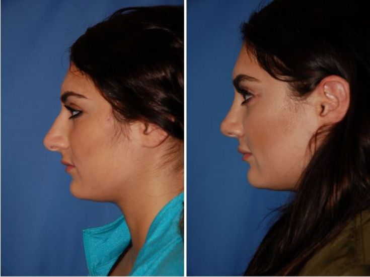 Rhinoplasty Portland Or