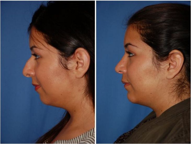 Rhinoplasty Multnomah County