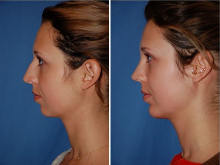 Rhinoplasty in Washington County OR