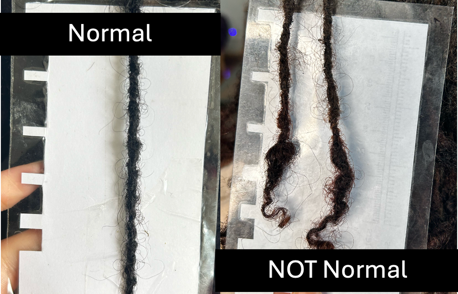 Normal vs abnormal microlocs