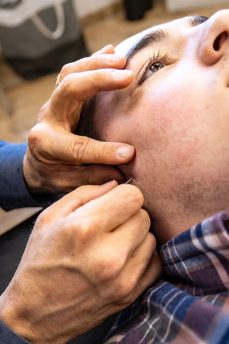 Physical therapist performing dry needling for TMD pain relief.
