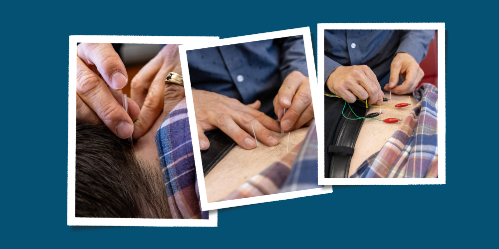 Physical therapist dry needling a patient