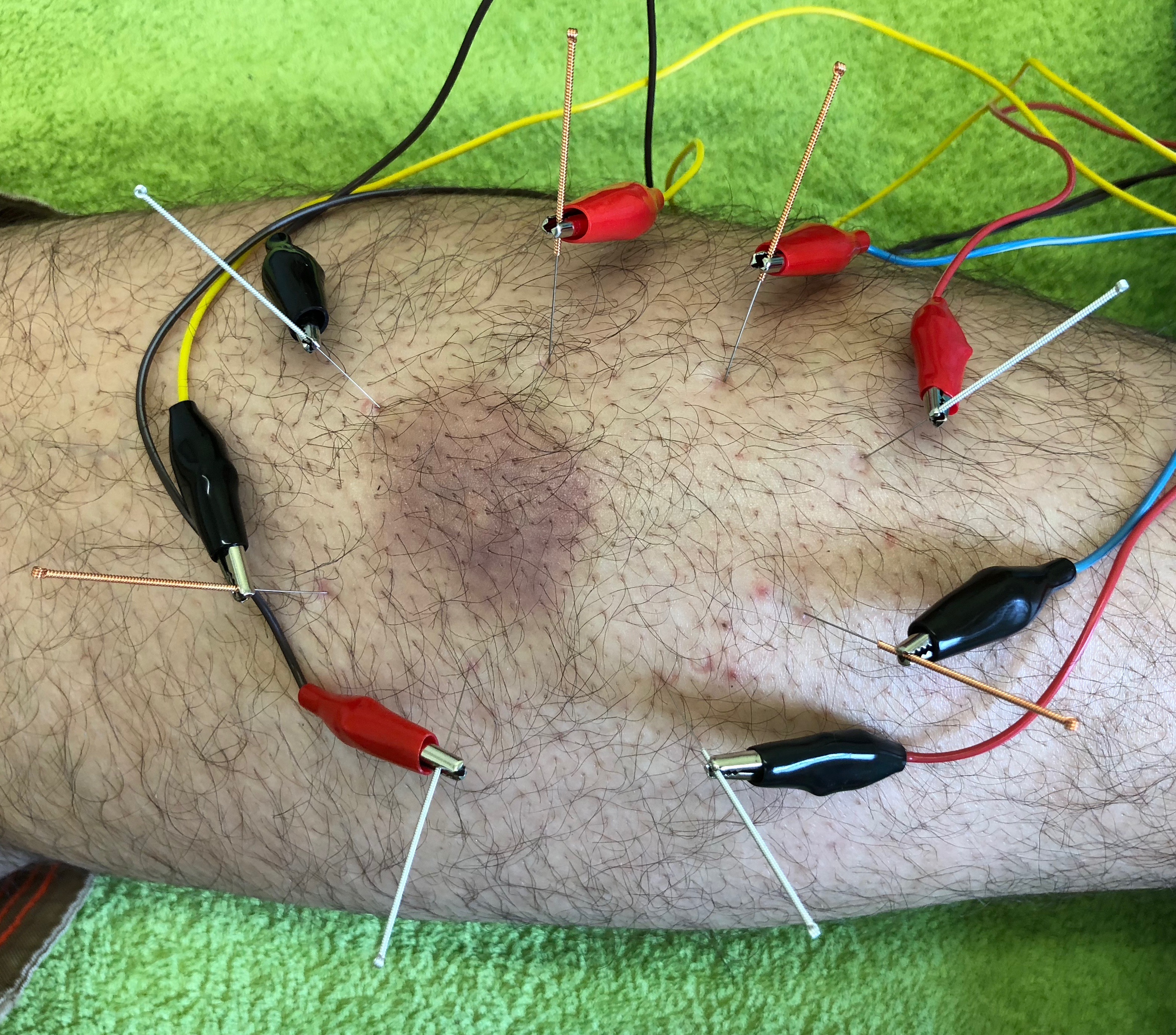 Electroacupuncture