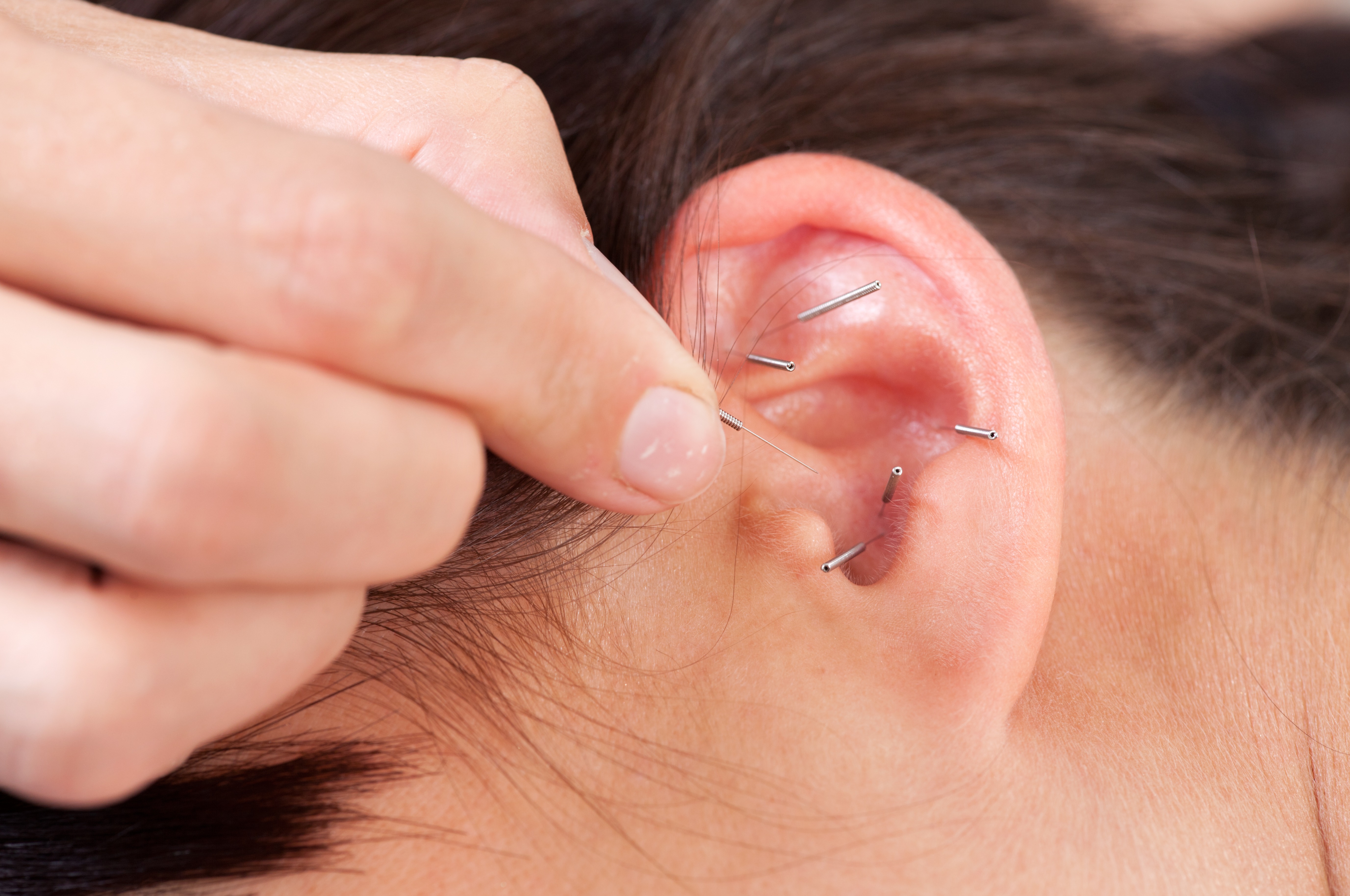 Ear acupuncture