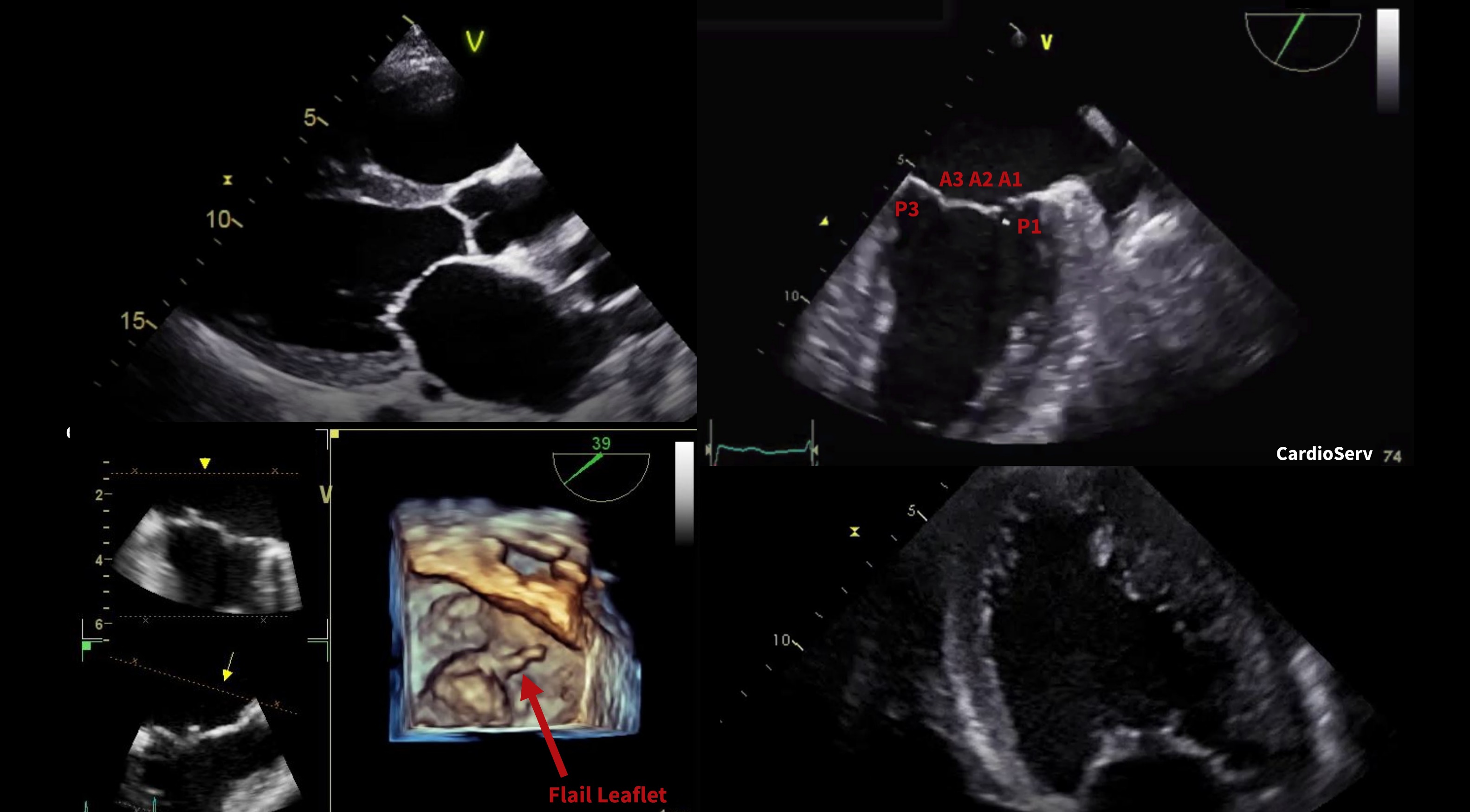Mitral Regurgitation Echo