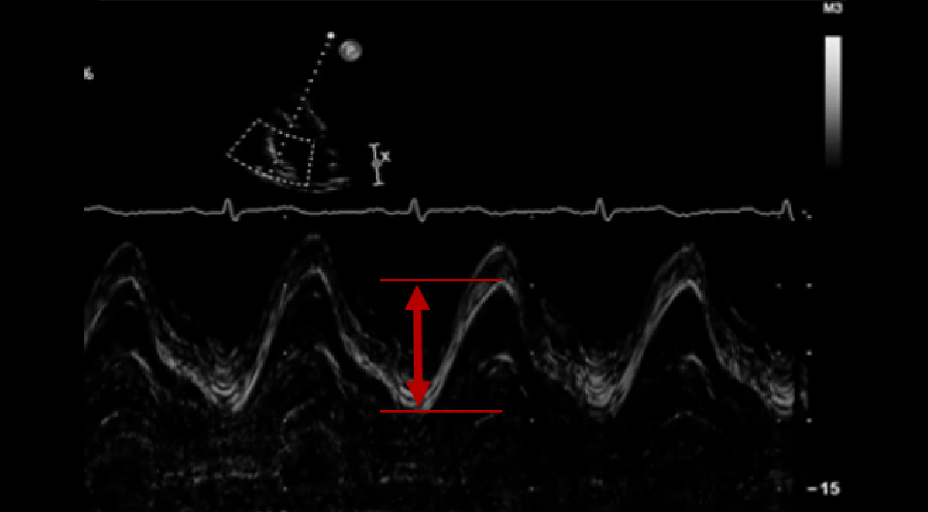 CME Right Heart Quantification Echocardiography