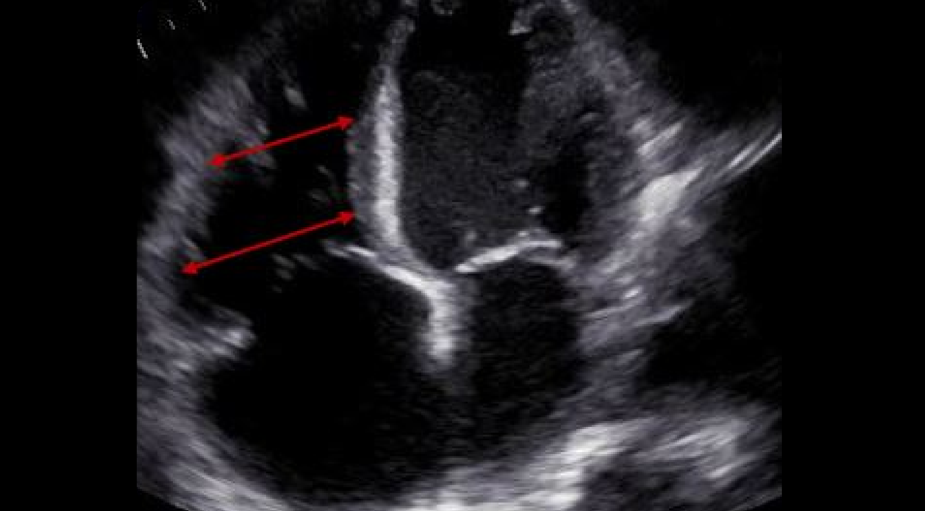 CME Right Ventricle & Right Atrium Size Echocardiography