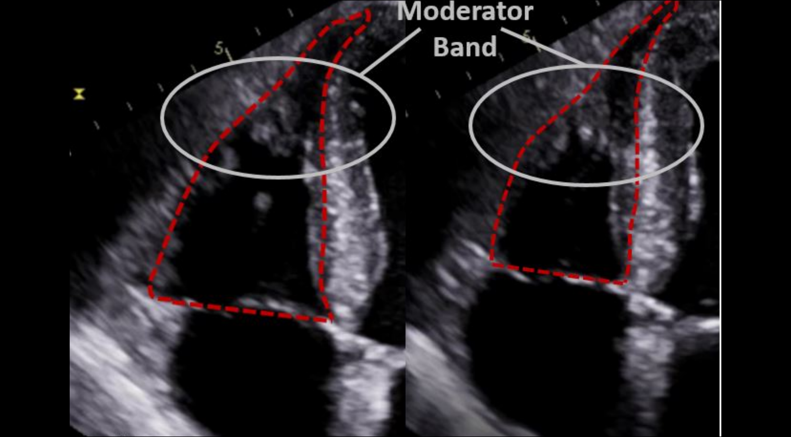 CME RV Function Using RIMP & FAC Echocardiography