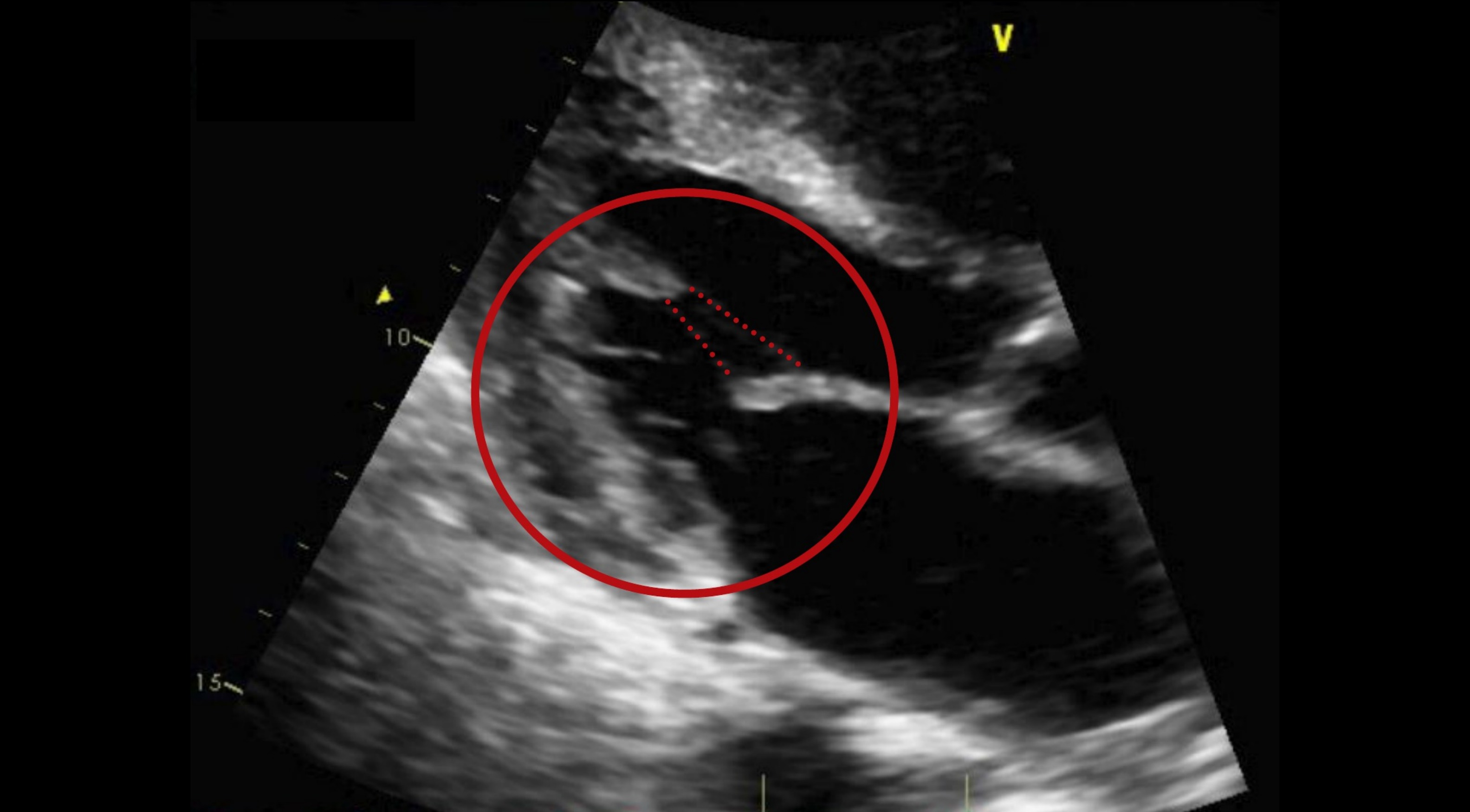 Mitral Valve Anatomy in Echocardiography (TTE and TEE)
