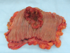 tumor