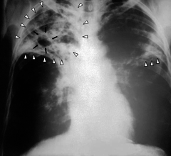 tuberculosis