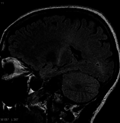Amyotropic lateral sclerosis