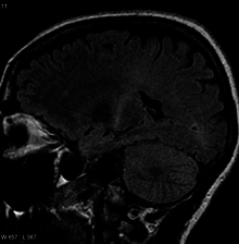 Amyotrophic lateral sclerosis