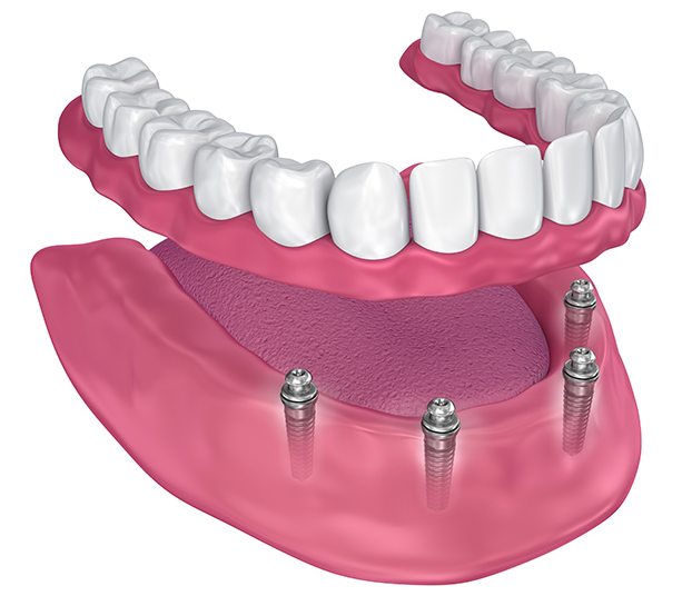 Dental Implants Get Outstanding Dental Implants And Revolutionize