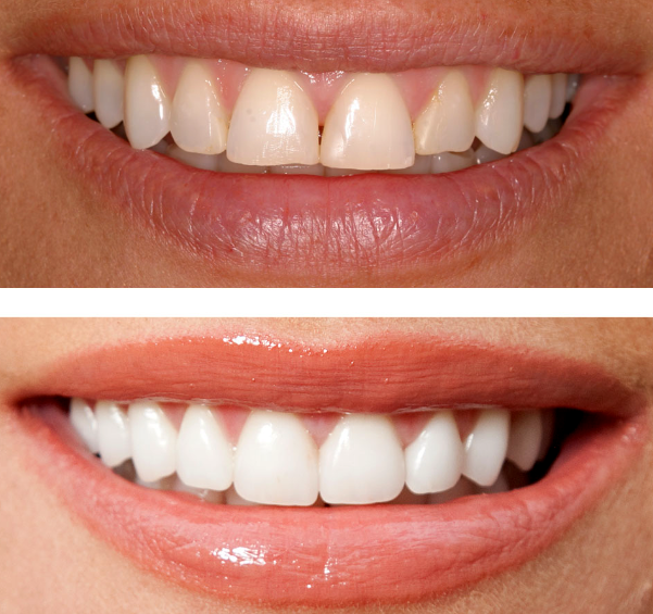 Dental Bonding Get The Best Dental Bonding at Anderson Dental