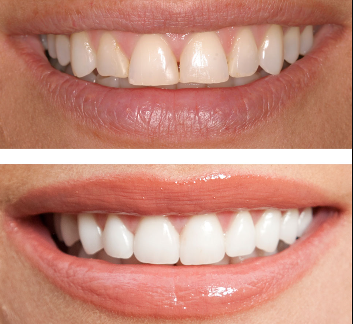 Teeth Bonding Improve The Look Of Teeth By Fixing Gaps, Small Cracks