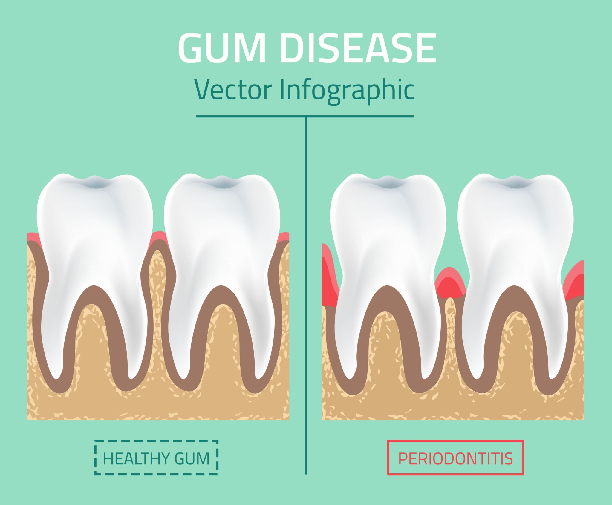 Image of gum before and after disease, fishers in