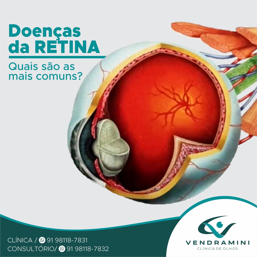 DOENÇAS DA RETINA - QUAIS SÃO AS MAIS COMUNS?