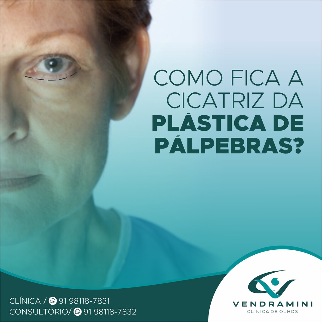 COMO FICA A CICATRIZ DA PLÁSTICA DE PÁLPEBRAS?