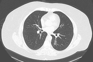 lungs