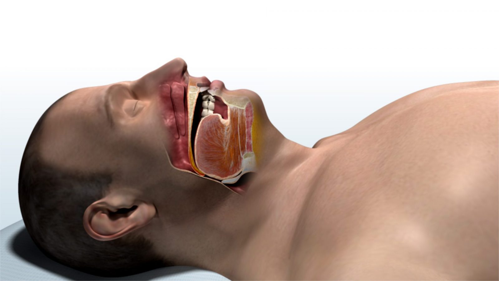 No mask, no hose, no noise. Just sleep. UCHealth Today