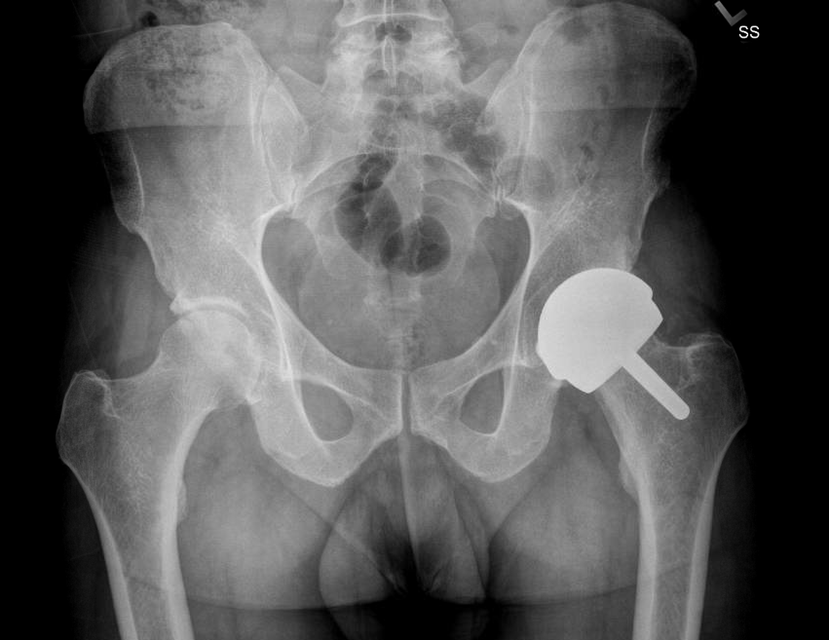 Hip procedure gets a soldier’s career back on track - UCHealth Today