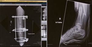 At right, an X-ray taken the day of the accident on June 26, 2016. At left, six weeks into the distraction osteogenesis on June 14, 2017. The idea was to close the gap at the point of injury by creating gap higher in the shin that would, with time, fill with new bone.