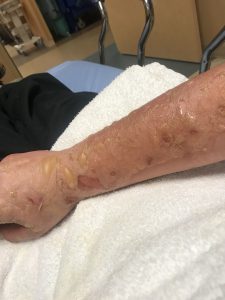 A young man ended up with severe burns and blisters after a cooking accident. He shows off his burnt arm.