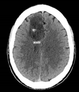 This is an image of the CT scan showing Todd Danielson's brain tumor.