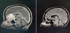 two MRIs, one which shows a large brain tumor and the other after surgery with the tumor gone but her brain hasn't filled in the space all the way yet.