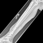 X-ray of leg with rods and pins in it.