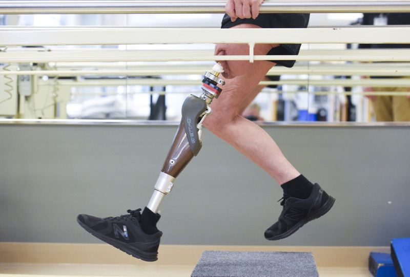 woman's two legs in running motion, one of which as the prosthetic attached through osseointegration surgery.